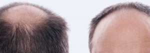 hair loss