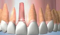 Dental Implant illustration 